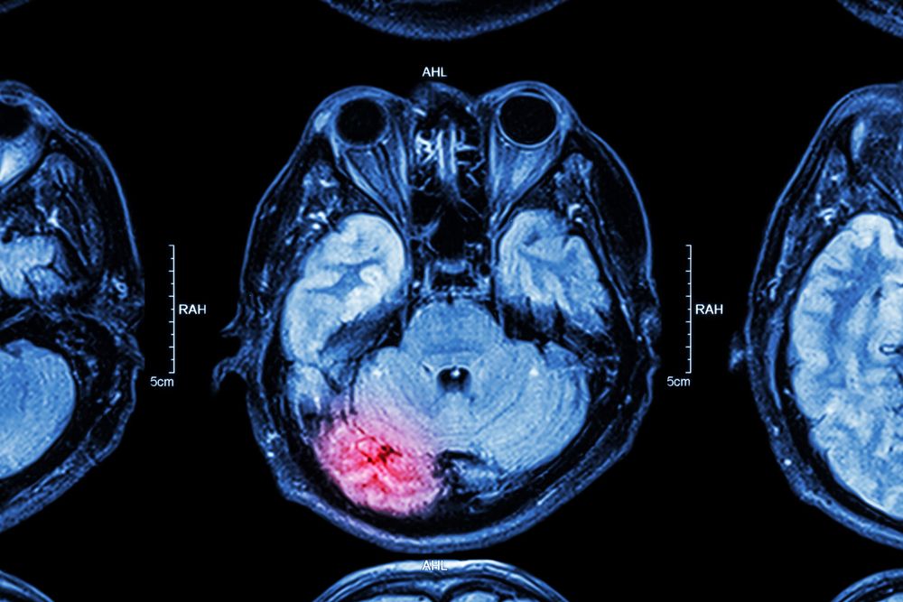 Understanding Traumatic Brain Injury (TBI) Claims: Seeking Compensation After a Serious Accident in New Jersey